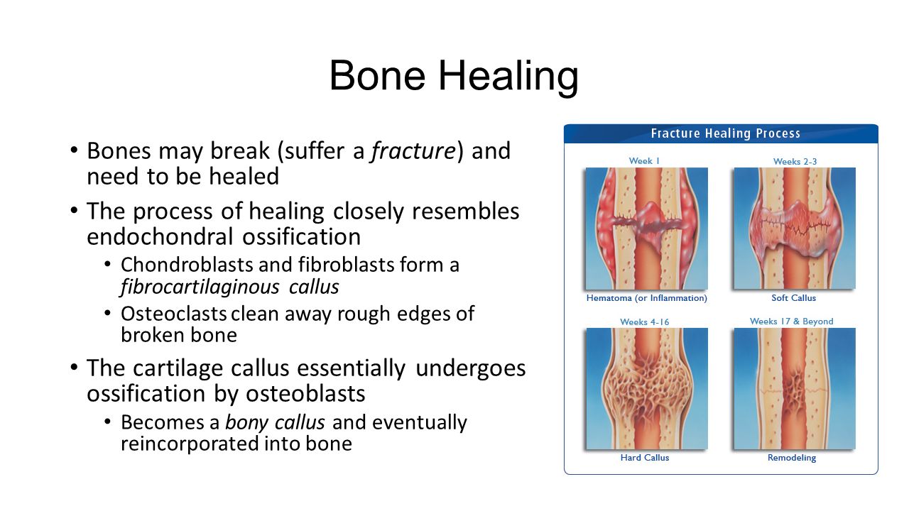 healing process of a bone fracture healing process of a bone fracture