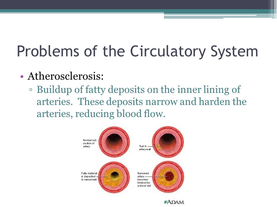 Problems of the Circulatory System Atherosclerosis: ▫Buildup of fatty deposits on the inner lining of arteries.
