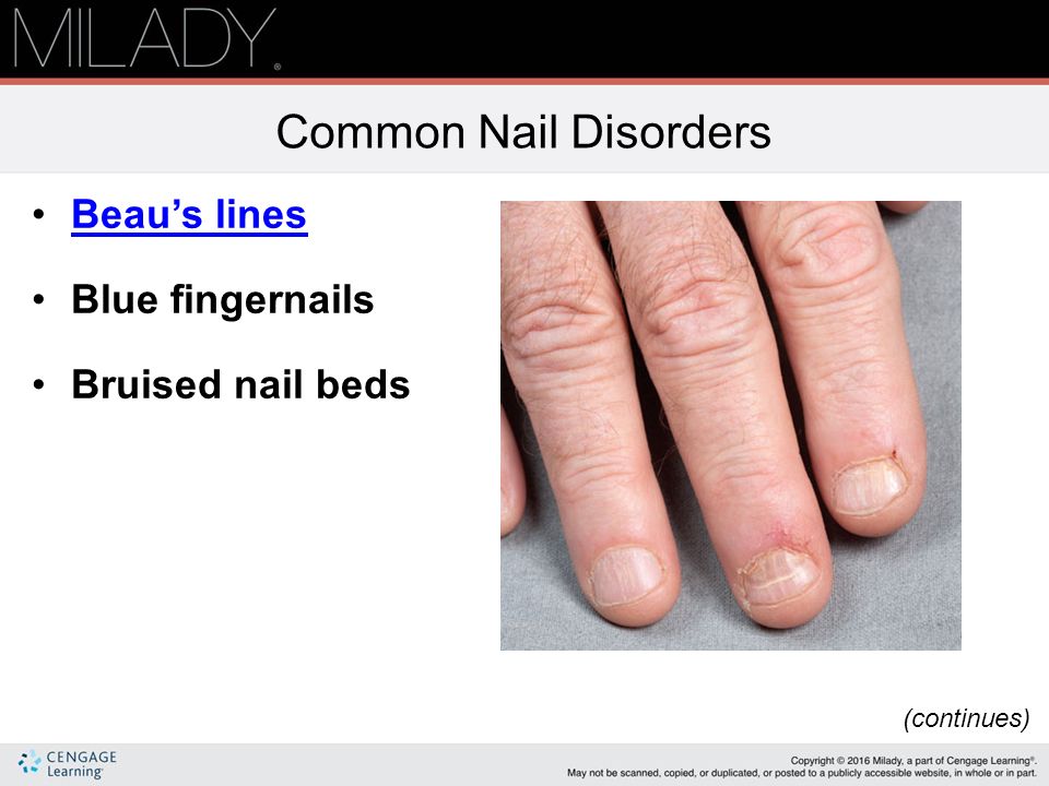 Nail Diseases And Disorders Milady Best Designs 2018 Nail Disorders Milady Best Designs 2018