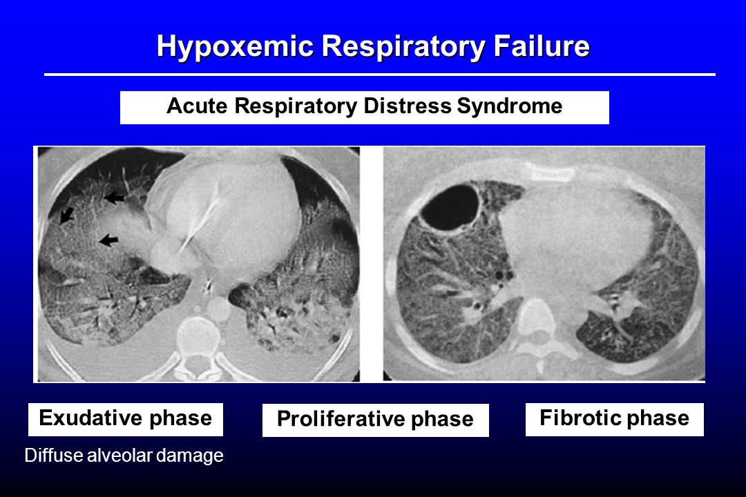 respiratory ards Special communication online first acute respiratory distress syndrome the berlin definition the ards definition task forcev alid and reliable defini. respiratory ards Special communication online first acute respiratory distress syndrome the berlin definition the ards definition task forcev alid and reliable defini.