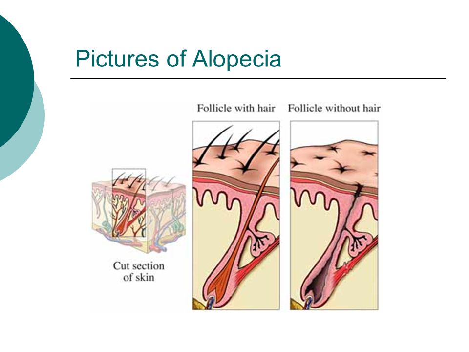 Pictures of Alopecia