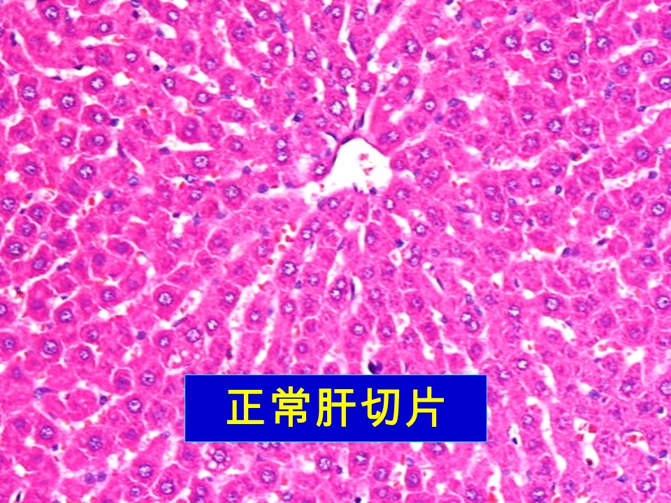 正常肝切片  3 4         病毒性肝炎(急性普通型) ※ 肝小叶结构