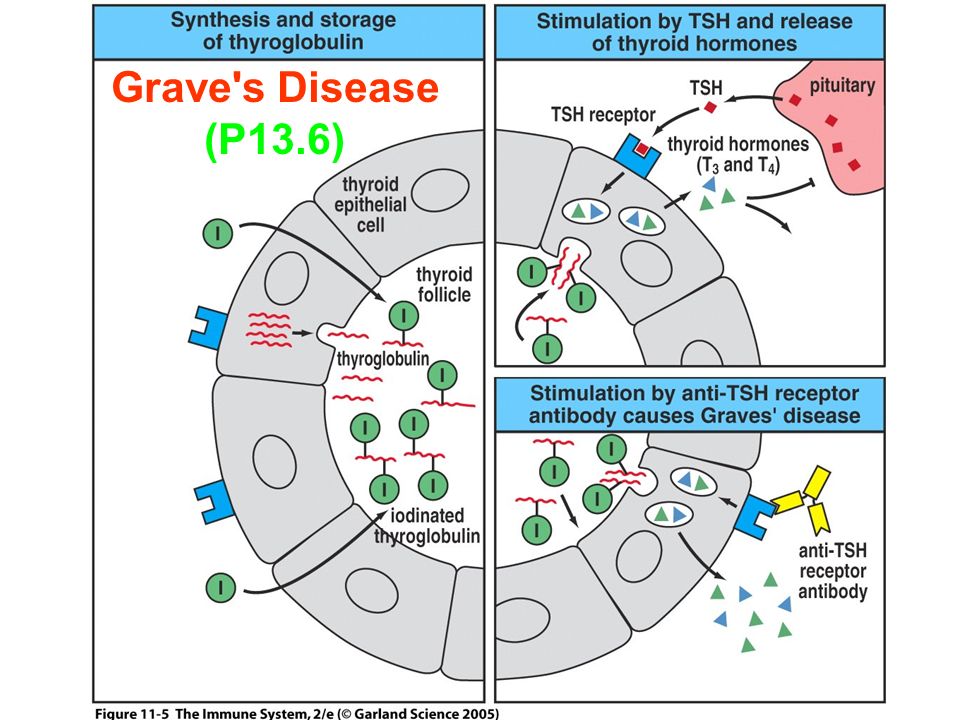 Figure 11-5 Grave s Disease (P13.6)