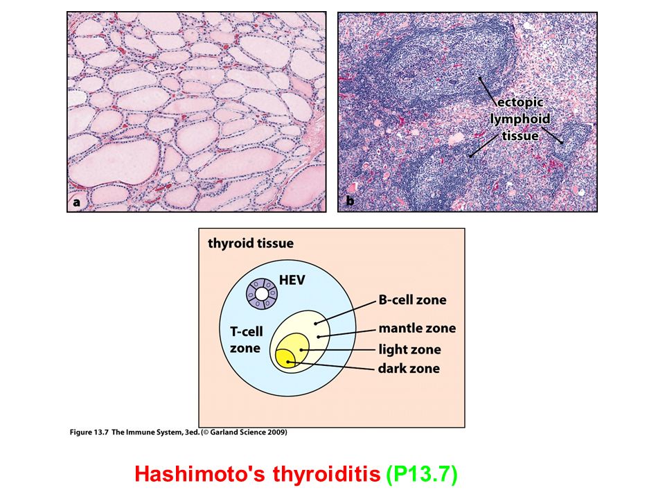 Hashimoto s thyroiditis (P13.7)
