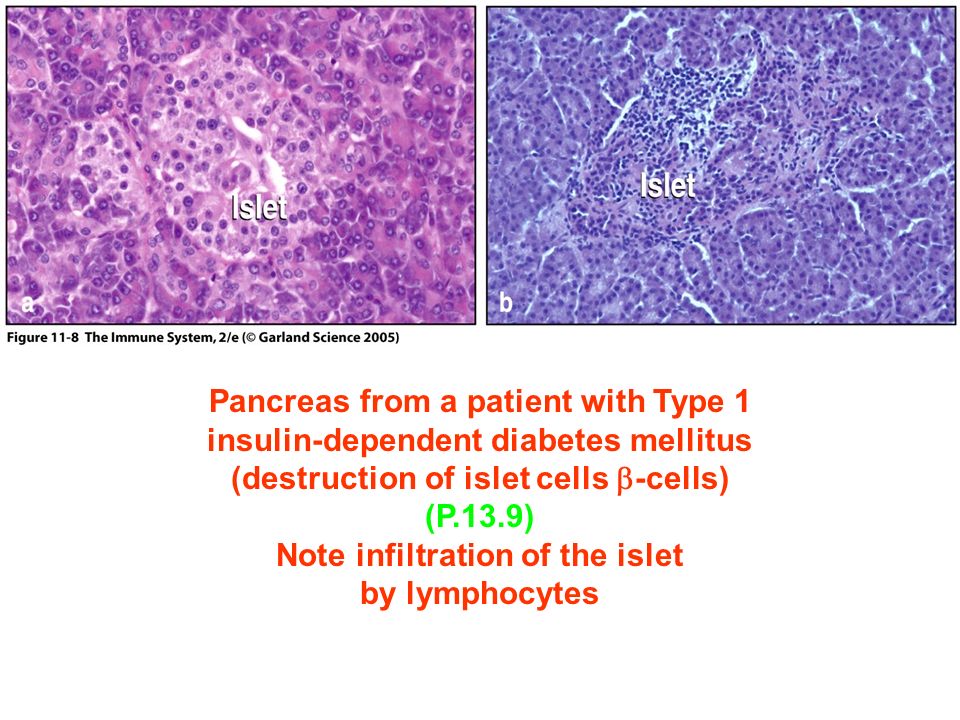 Figure 11-8 Pancreas from a patient with Type 1 insulin-dependent diabetes mellitus (destruction of islet cells  -cells) (P.13.9) Note infiltration of the islet by lymphocytes