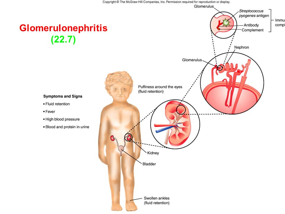 Glomerulonephritis (22.7)