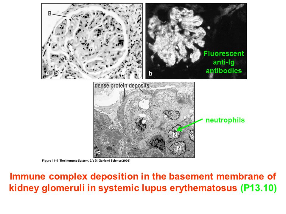 Immune complex deposition in the basement membrane of kidney glomeruli in systemic lupus erythematosus (P13.10) neutrophils Fluorescent anti-Ig antibodies