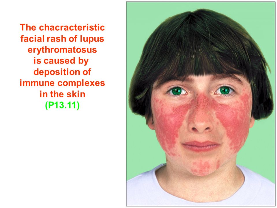 Figure The chacracteristic facial rash of lupus erythromatosus is caused by deposition of immune complexes in the skin (P13.11)