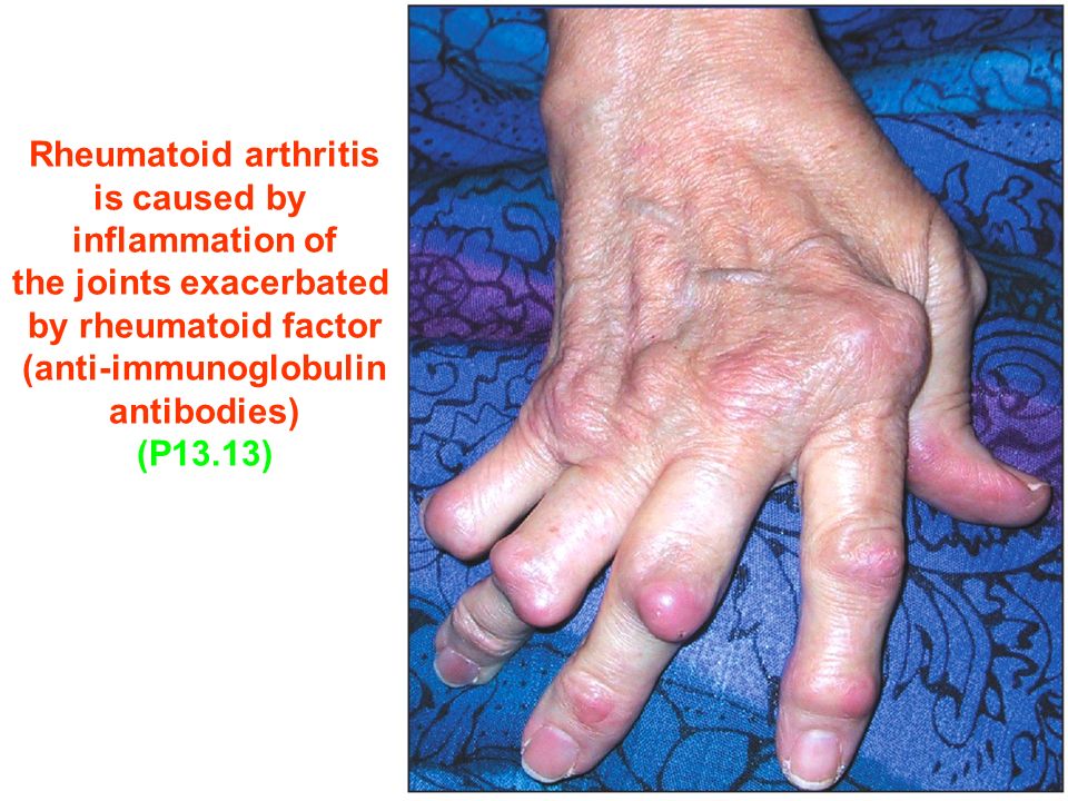 Figure Rheumatoid arthritis is caused by inflammation of the joints exacerbated by rheumatoid factor (anti-immunoglobulin antibodies) (P13.13)