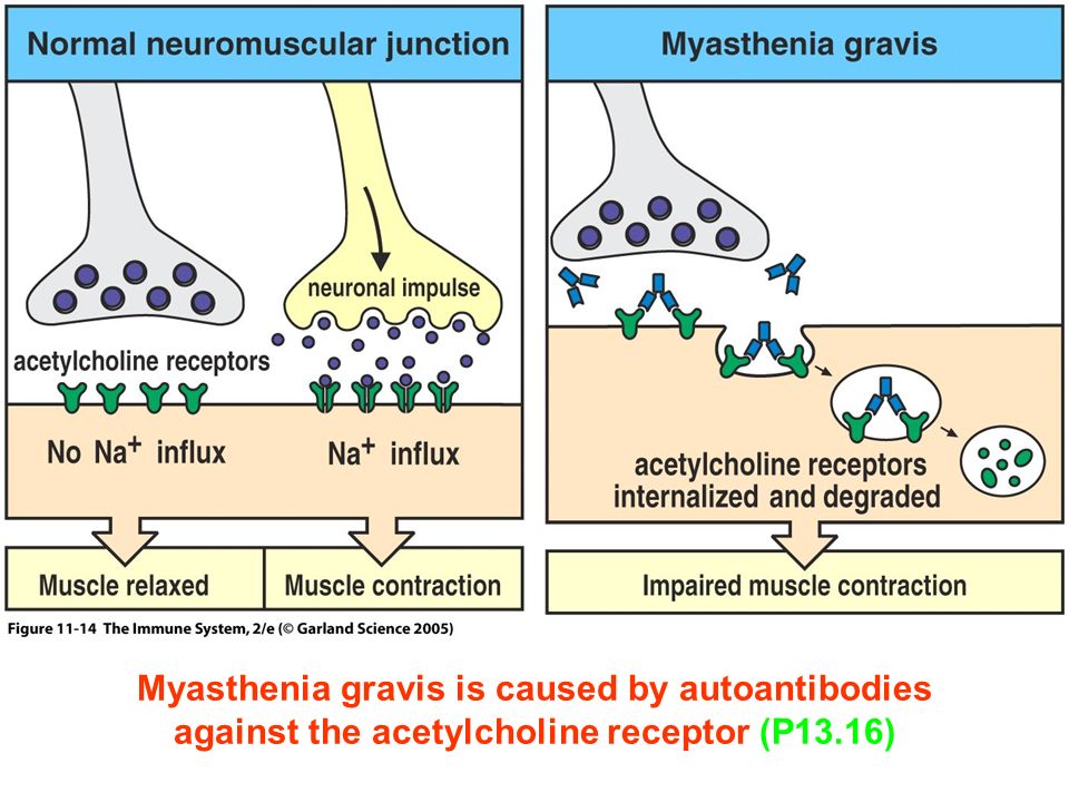 Figure Myasthenia gravis is caused by autoantibodies against the acetylcholine receptor (P13.16)