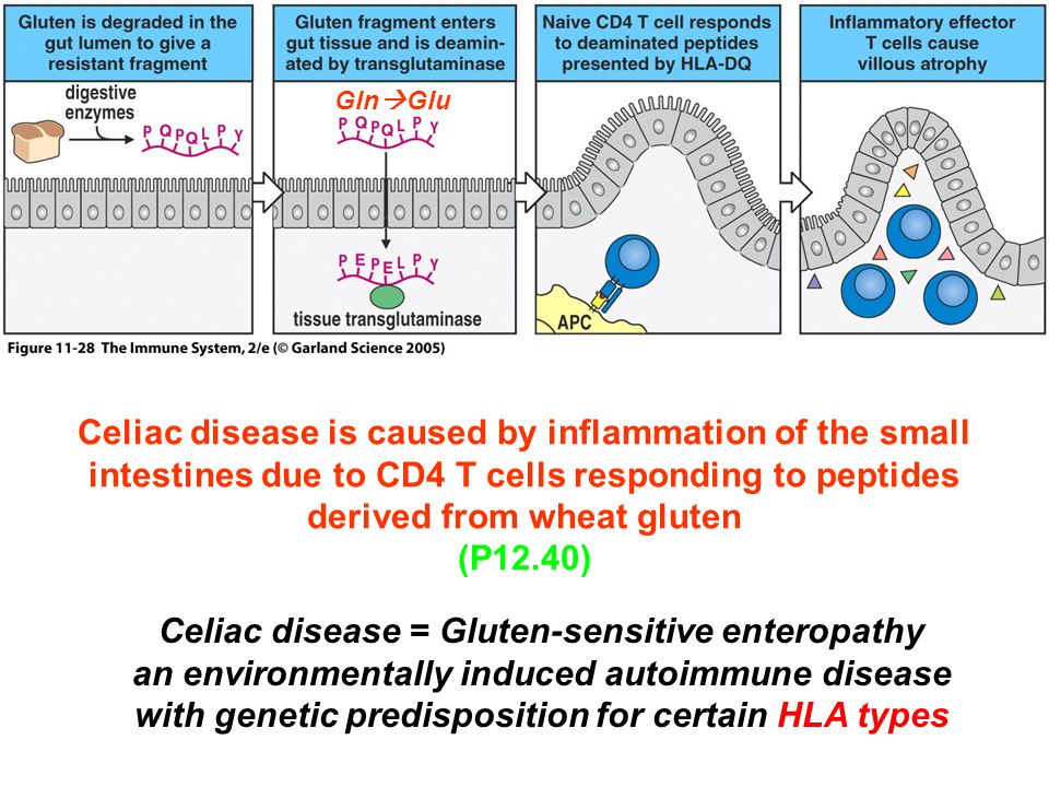 Figure Celiac disease is caused by inflammation of the small intestines due to CD4 T cells responding to peptides derived from wheat gluten (P12.40) Celiac disease = Gluten-sensitive enteropathy an environmentally induced autoimmune disease with genetic predisposition for certain HLA types Gln  Glu