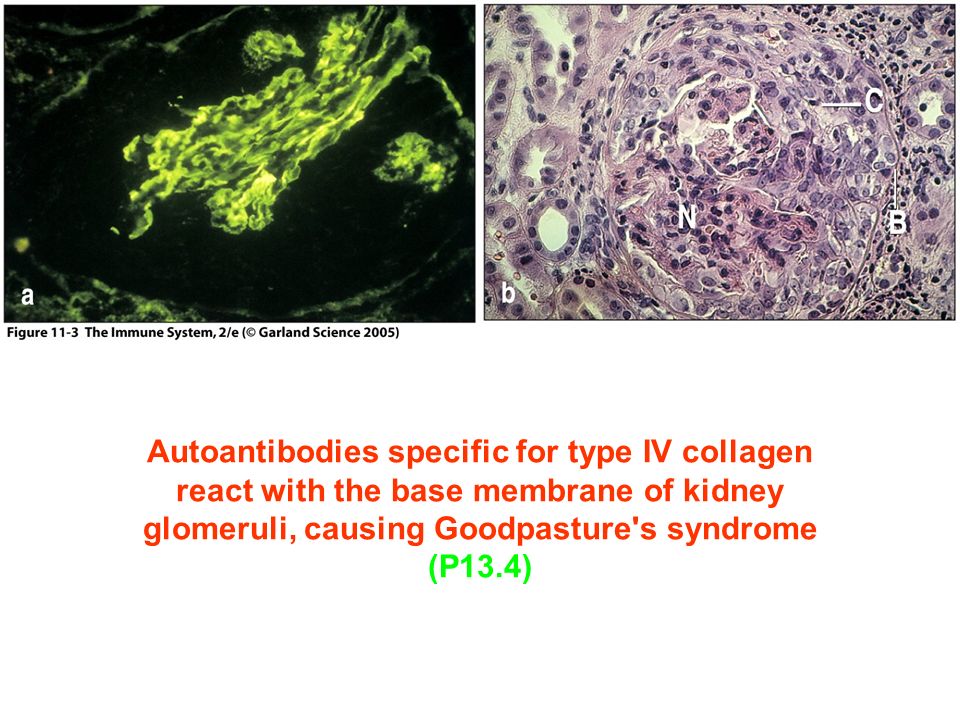 Figure 11-3 Autoantibodies specific for type IV collagen react with the base membrane of kidney glomeruli, causing Goodpasture s syndrome (P13.4)