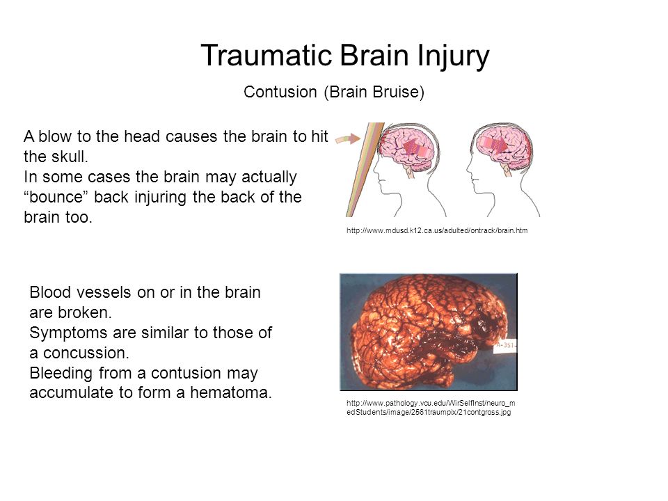 an introduction to a concussion a bruise to the brain Learn about the symptoms of concussion (traumatic brain injury symptoms of a broken bone include pain at the site of injury, swelling, and bruising around the. an introduction to a concussion a bruise to the brain Learn about the symptoms of concussion (traumatic brain injury symptoms of a broken bone include pain at the site of injury, swelling, and bruising around the.