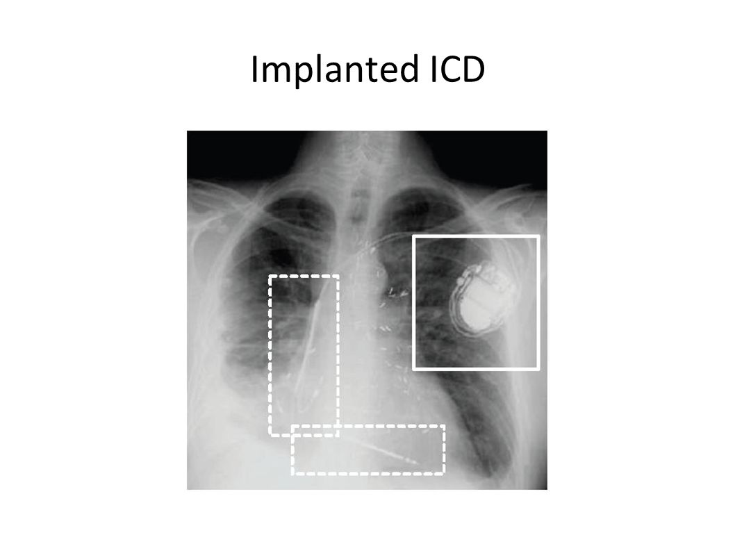 Implanted ICD