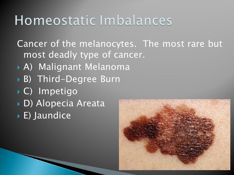 malignant melanoma essay This is the first page of cancernet’s guide to melanoma a cancerous tumor is malignant, meaning it can grow and spread to other parts of the body. malignant melanoma essay This is the first page of cancernet’s guide to melanoma a cancerous tumor is malignant, meaning it can grow and spread to other parts of the body.