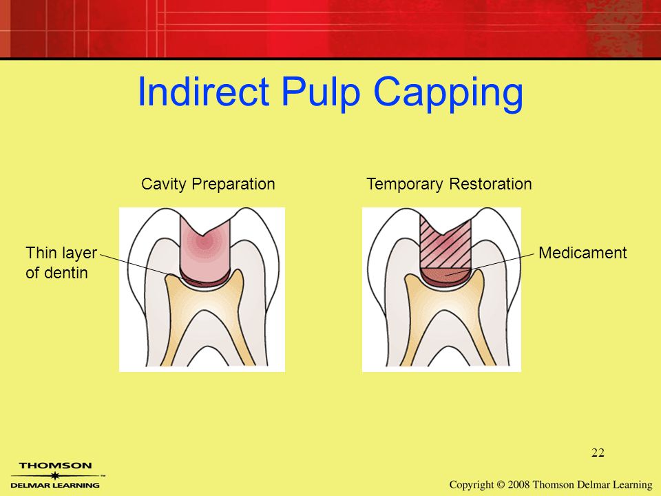 indirect pulp cap