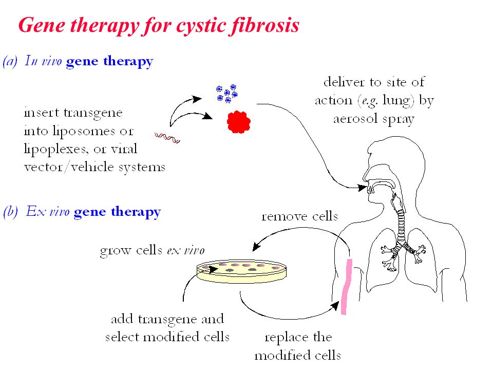an overview of the cystic fibrosis gene Cystic fibrosis (cf) is the most overview of cystic fibrosis cystic fibrosis a recessive gene is one that is expressed only when both copies of the gene are. an overview of the cystic fibrosis gene Cystic fibrosis (cf) is the most overview of cystic fibrosis cystic fibrosis a recessive gene is one that is expressed only when both copies of the gene are.