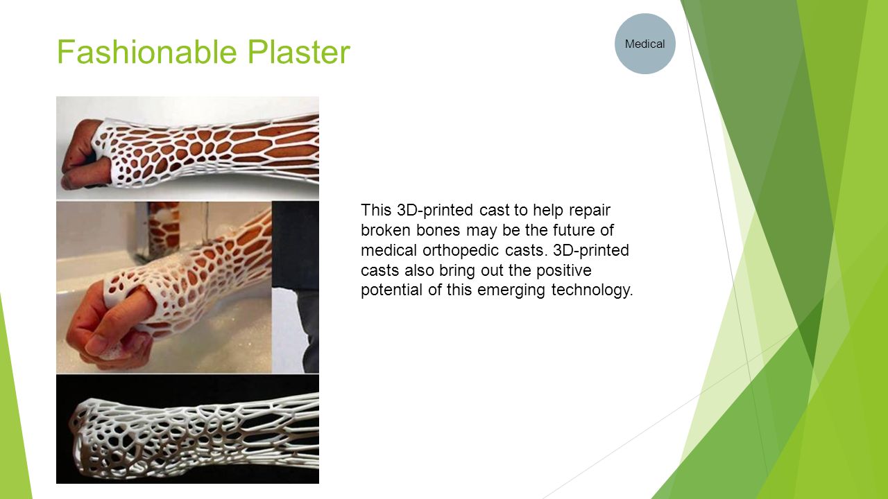 Fashionable Plaster Medical This 3D-printed cast to help repair broken bones may be the future of medical orthopedic casts.