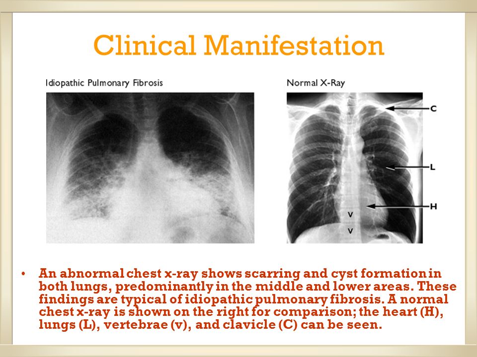 pulmonary fibrosis Pulmonary fibrosis the following is a brief overview of this condition for more information, please refer to the guidelines from the for further guidelines, please refer to the british thoracic society and the british lung foundation what is pulmonary fibrosis. pulmonary fibrosis Pulmonary fibrosis the following is a brief overview of this condition for more information, please refer to the guidelines from the for further guidelines, please refer to the british thoracic society and the british lung foundation what is pulmonary fibrosis.