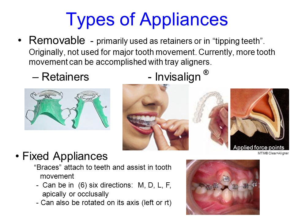 Types of Appliances Removable - primarily used as retainers or in tipping teeth .