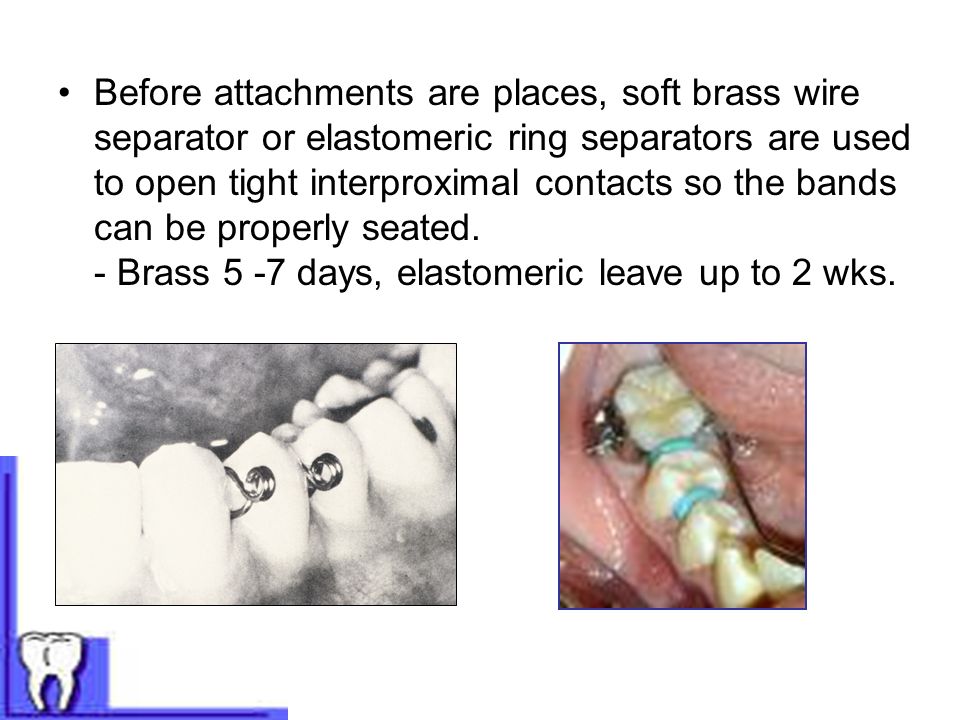 Before attachments are places, soft brass wire separator or elastomeric ring separators are used to open tight interproximal contacts so the bands can be properly seated.