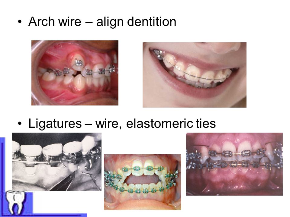 Arch wire – align dentition Ligatures – wire, elastomeric ties