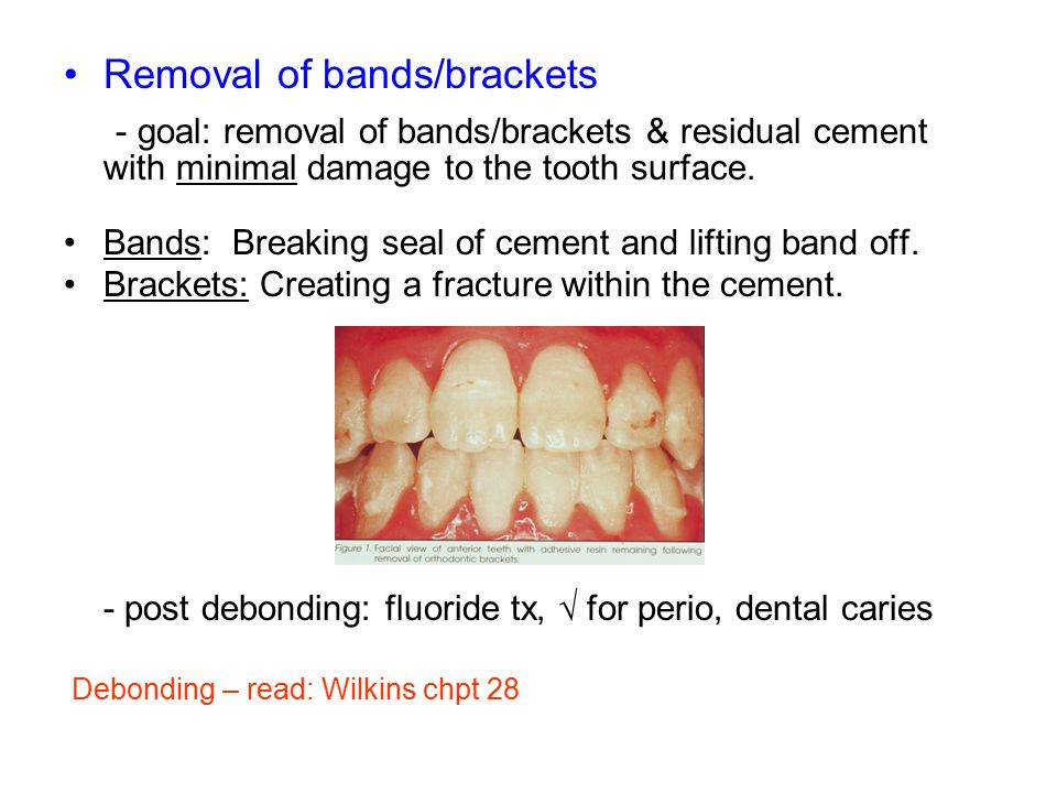 Removal of bands/brackets - goal: removal of bands/brackets & residual cement with minimal damage to the tooth surface.