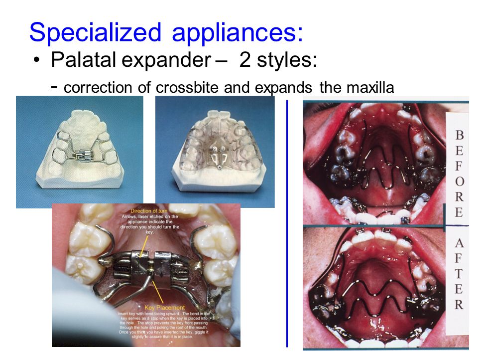 Specialized appliances: Palatal expander – 2 styles: - correction of crossbite and expands the maxilla