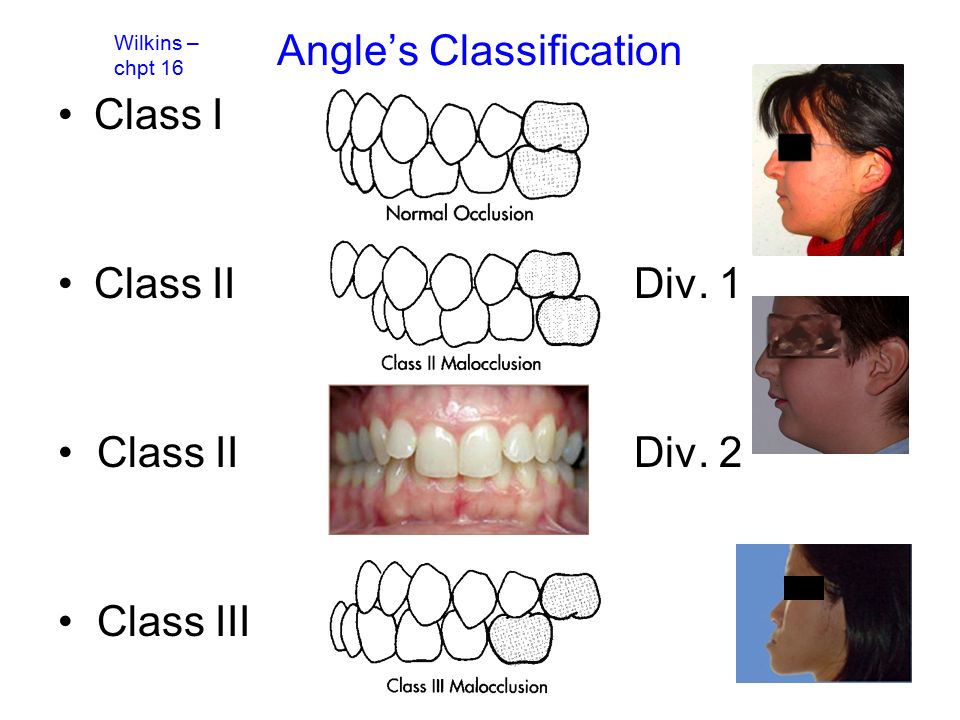 Angle’s Classification Class I Class II Div. 1 Class IIDiv. 2 Class III Wilkins – chpt 16
