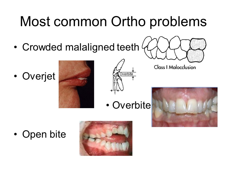 Most common Ortho problems Crowded malaligned teeth Overjet Overbite Open bite