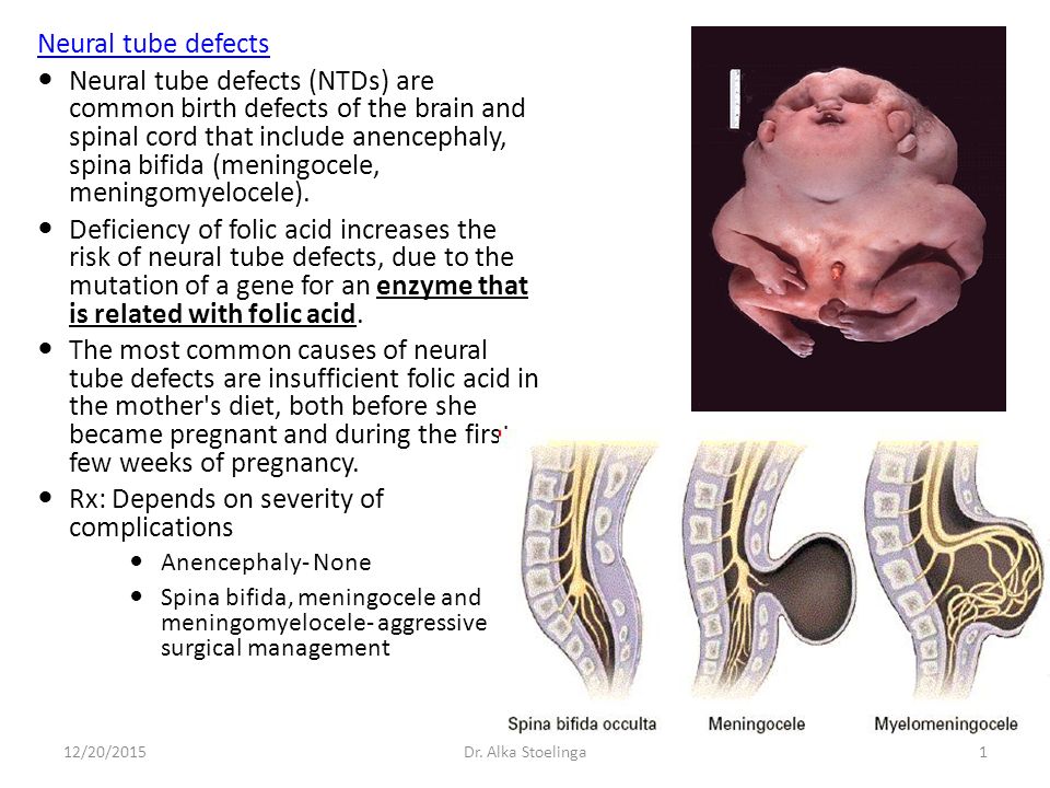 neural tube defects