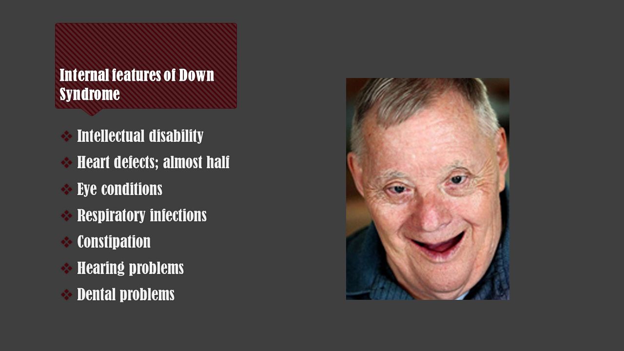 Downs Syndrome Facial Features