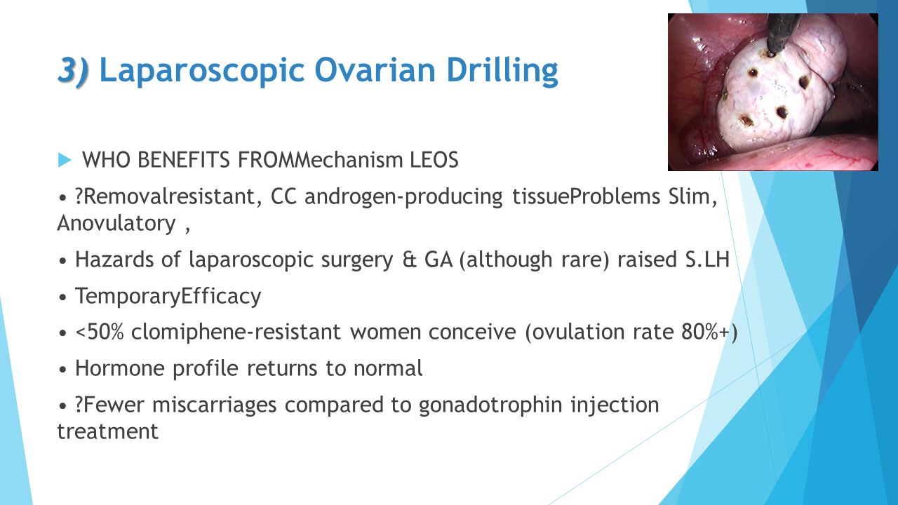 Ovary Drilling And Clomid