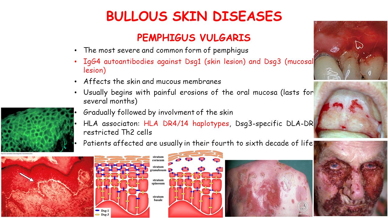 BULLOUS SKIN DISEASES PEMPHIGUS VULGARIS The most severe and common form of pemphigus IgG4 autoantibodies against Dsg1 (skin lesion) and Dsg3 (mucosal lesion) Affects the skin and mucous membranes Usually begins with painful erosions of the oral mucosa (lasts for several months) Gradually followed by involvment of the skin HLA associaton: HLA DR4/14 haplotypes, Dsg3-specific DLA-DR restricted Th2 cells Patients affected are usually in their fourth to sixth decade of life