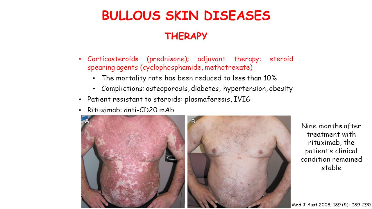 BULLOUS SKIN DISEASES THERAPY Corticosteroids (prednisone); adjuvant therapy: steroid spearing agents (cyclophosphamide, methotrexate) The mortality rate has been reduced to less than 10% Complictions: osteoporosis, diabetes, hypertension, obesity Patient resistant to steroids: plasmaferesis, IVIG Rituximab: anti-CD20 mAb Med J Aust 2008; 189 (5):