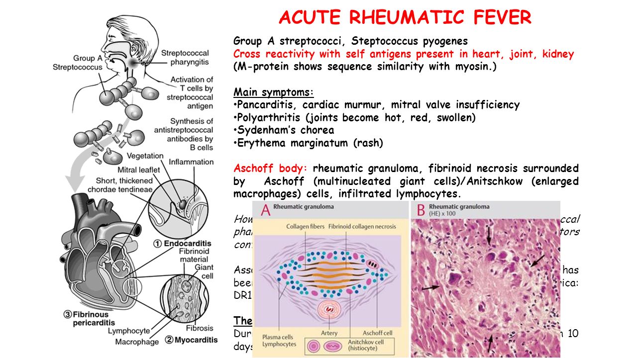 ACUTE RHEUMATIC FEVER Group A streptococci, Steptococcus pyogenes Cross reactivity with self antigens present in heart, joint, kidney (M-protein shows sequence similarity with myosin.) Main symptoms: Pancarditis, cardiac murmur, mitral valve insufficiency Polyarthritis (joints become hot, red, swollen) Sydenham’s chorea Erythema marginatum (rash) Aschoff body: rheumatic granuloma, fibrinoid necrosis surrounded by Aschoff (multinucleated giant cells)/Anitschkow (enlarged macrophages) cells, infiltrated lymphocytes.