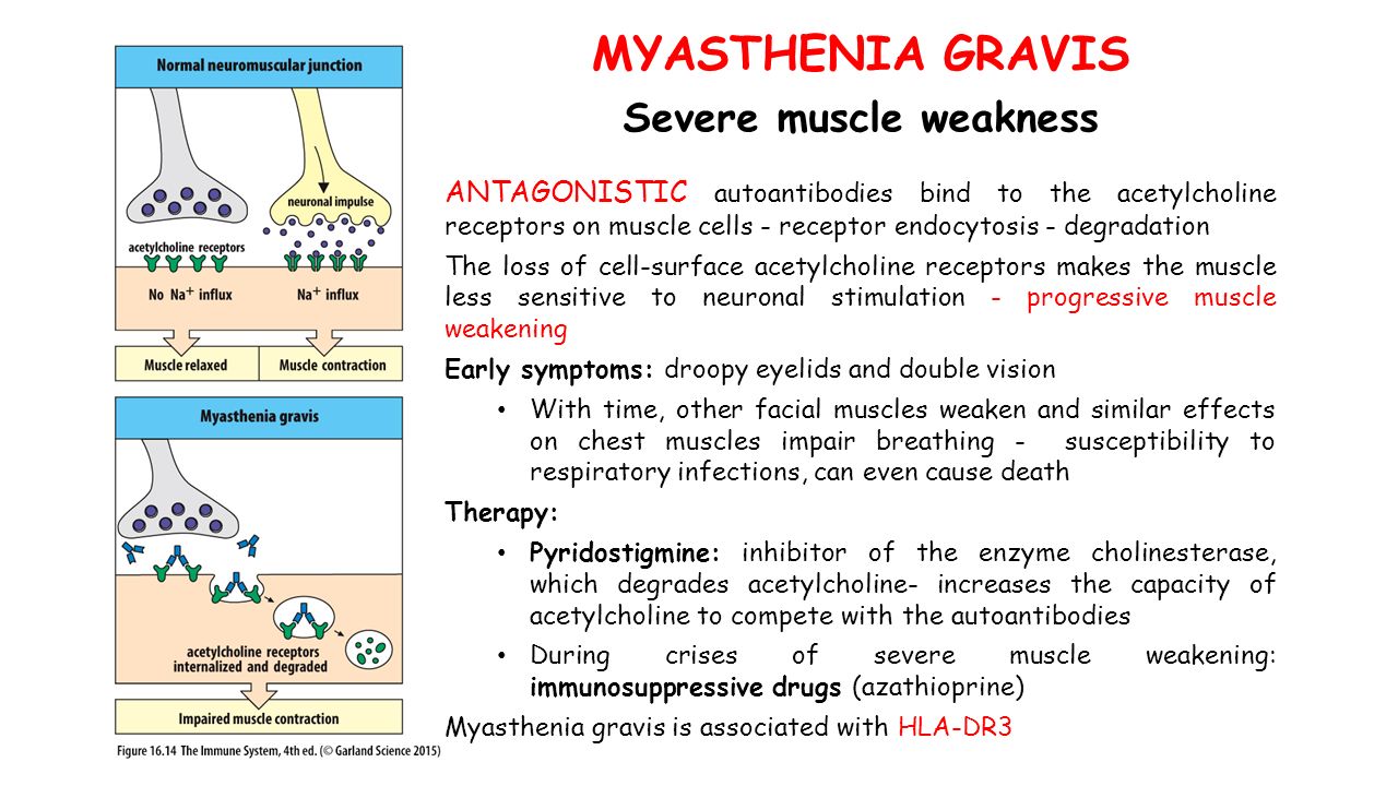 MYASTHENIA GRAVIS Severe muscle weakness ANTAGONISTIC autoantibodies bind to the acetylcholine receptors on muscle cells - receptor endocytosis - degradation The loss of cell-surface acetylcholine receptors makes the muscle less sensitive to neuronal stimulation - progressive muscle weakening Early symptoms: droopy eyelids and double vision With time, other facial muscles weaken and similar effects on chest muscles impair breathing - susceptibility to respiratory infections, can even cause death Therapy: Pyridostigmine: inhibitor of the enzyme cholinesterase, which degrades acetylcholine- increases the capacity of acetylcholine to compete with the autoantibodies During crises of severe muscle weakening: immunosuppressive drugs (azathioprine) Myasthenia gravis is associated with HLA-DR3