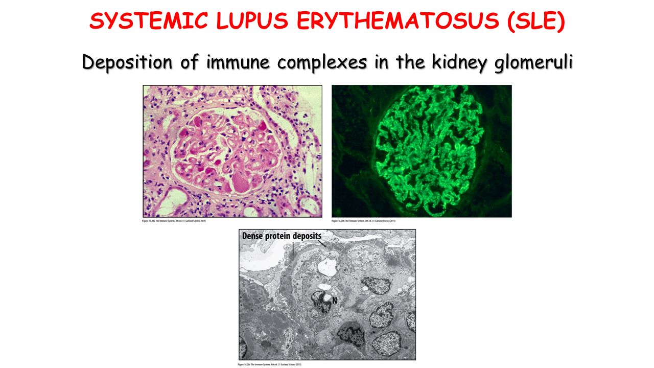 Deposition of immune complexes in the kidney glomeruli SYSTEMIC LUPUS ERYTHEMATOSUS (SLE)