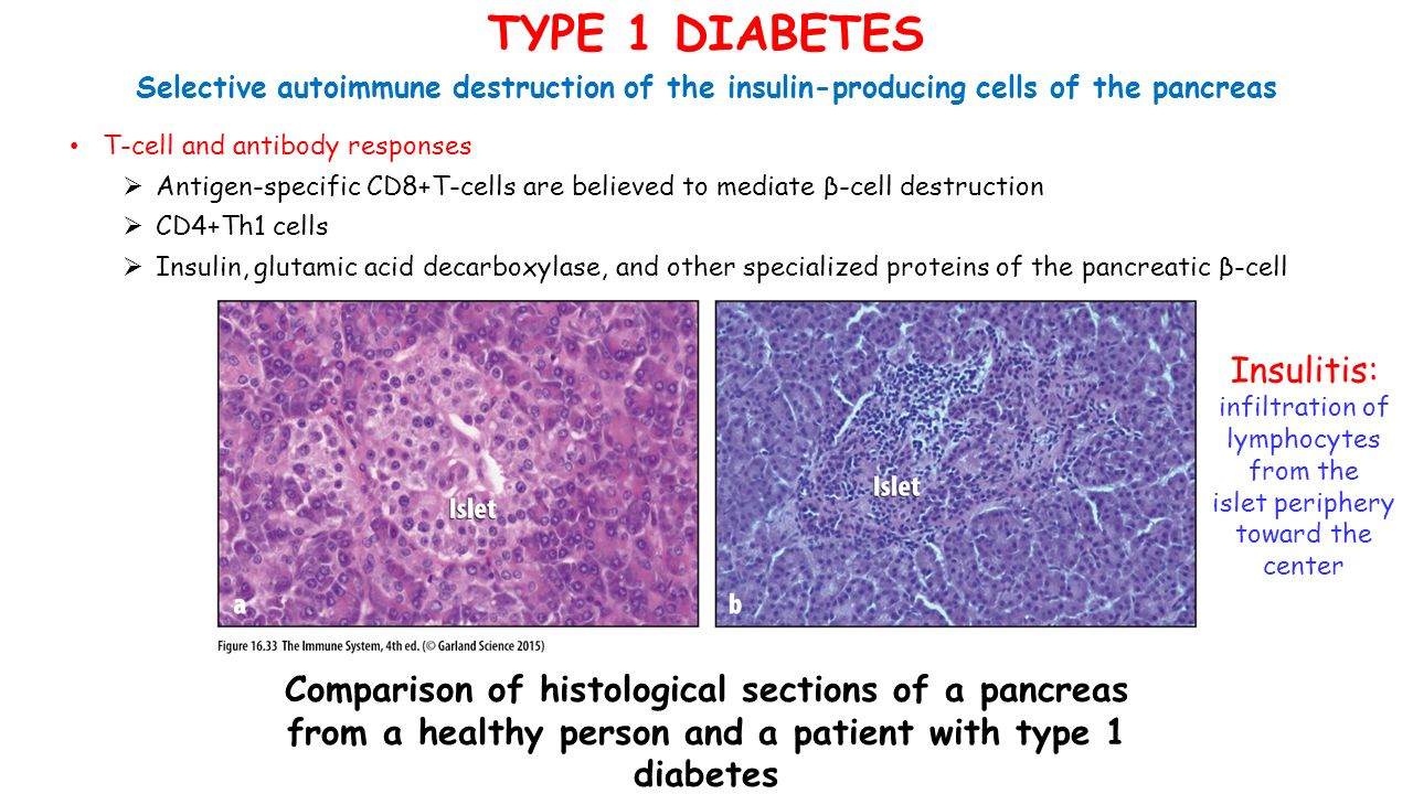 TYPE 1 DIABETES T-cell and antibody responses  Antigen-specific CD8+T-cells are believed to mediate β-cell destruction  CD4+Th1 cells  Insulin, glutamic acid decarboxylase, and other specialized proteins of the pancreatic β-cell Selective autoimmune destruction of the insulin-producing cells of the pancreas Comparison of histological sections of a pancreas from a healthy person and a patient with type 1 diabetes Insulitis: infiltration of lymphocytes from the islet periphery toward the center
