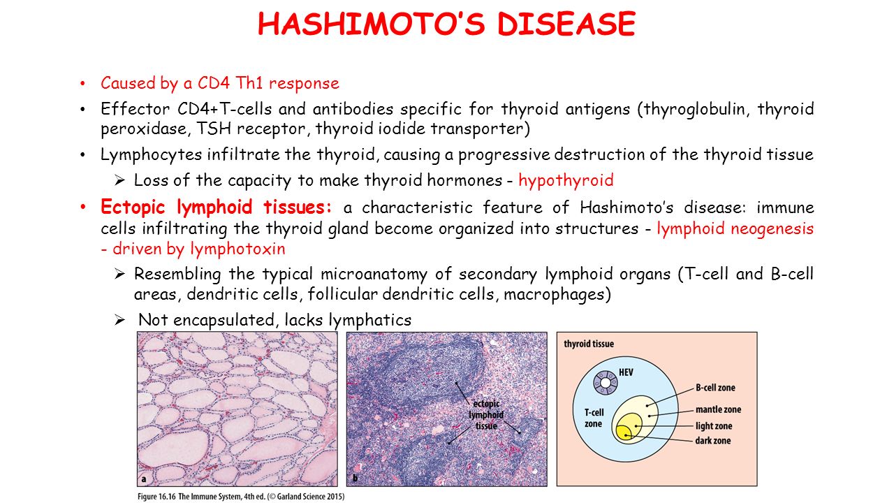 HASHIMOTO’S DISEASE Caused by a CD4 Th1 response Effector CD4+T-cells and antibodies specific for thyroid antigens (thyroglobulin, thyroid peroxidase, TSH receptor, thyroid iodide transporter) Lymphocytes infiltrate the thyroid, causing a progressive destruction of the thyroid tissue  Loss of the capacity to make thyroid hormones - hypothyroid Ectopic lymphoid tissues: a characteristic feature of Hashimoto’s disease: immune cells infiltrating the thyroid gland become organized into structures - lymphoid neogenesis - driven by lymphotoxin  Resembling the typical microanatomy of secondary lymphoid organs (T-cell and B-cell areas, dendritic cells, follicular dendritic cells, macrophages)  Not encapsulated, lacks lymphatics