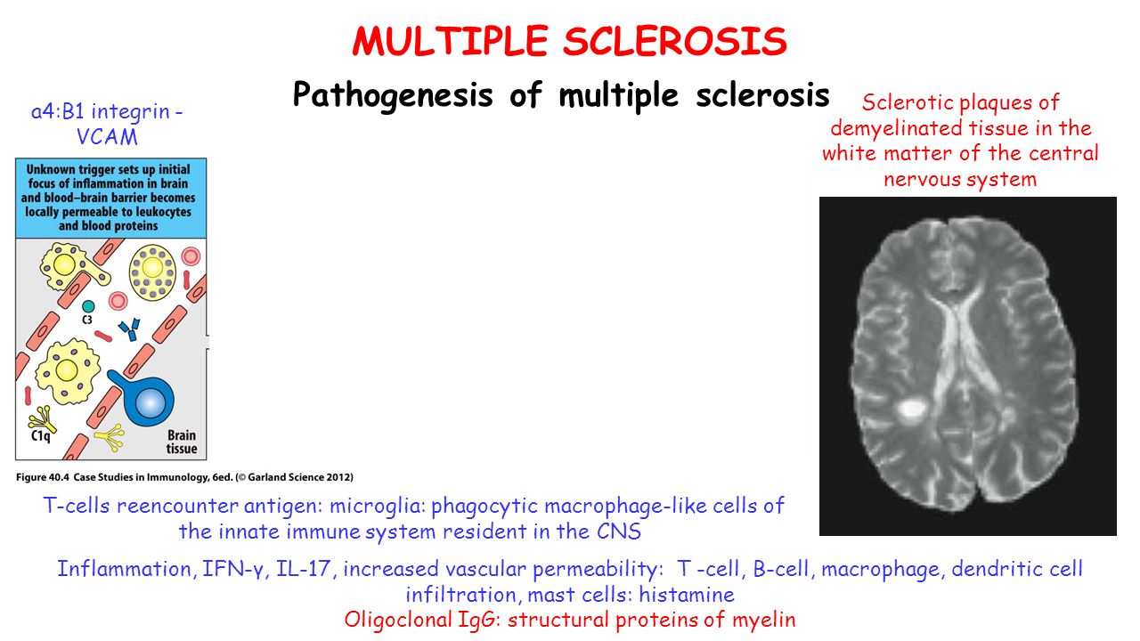 MULTIPLE SCLEROSIS Pathogenesis of multiple sclerosis a4:B1 integrin - VCAM T-cells reencounter antigen: microglia: phagocytic macrophage-like cells of the innate immune system resident in the CNS Inflammation, IFN-γ, IL-17, increased vascular permeability: T -cell, B-cell, macrophage, dendritic cell infiltration, mast cells: histamine Oligoclonal IgG: structural proteins of myelin Sclerotic plaques of demyelinated tissue in the white matter of the central nervous system