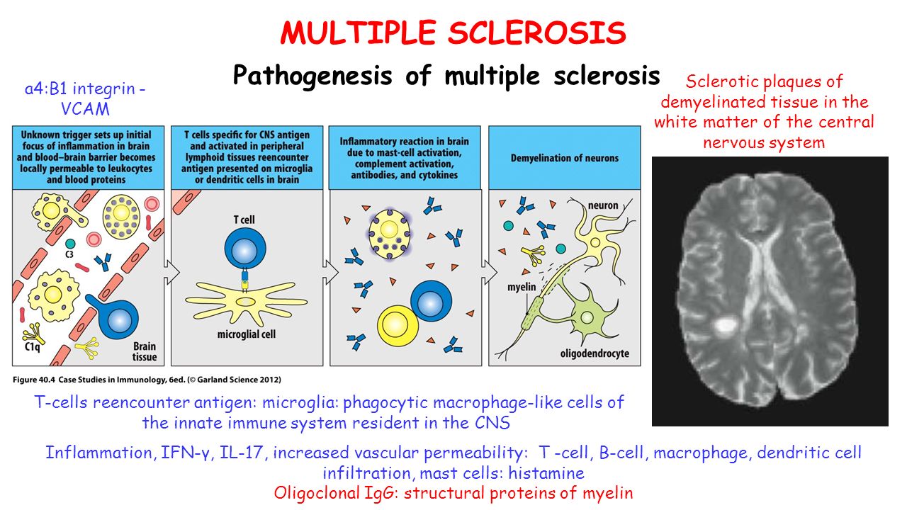 MULTIPLE SCLEROSIS Pathogenesis of multiple sclerosis a4:B1 integrin - VCAM T-cells reencounter antigen: microglia: phagocytic macrophage-like cells of the innate immune system resident in the CNS Inflammation, IFN-γ, IL-17, increased vascular permeability: T -cell, B-cell, macrophage, dendritic cell infiltration, mast cells: histamine Oligoclonal IgG: structural proteins of myelin Sclerotic plaques of demyelinated tissue in the white matter of the central nervous system