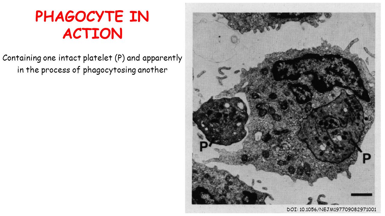 DOI: /NEJM PHAGOCYTE IN ACTION Containing one intact platelet (P) and apparently in the process of phagocytosing another