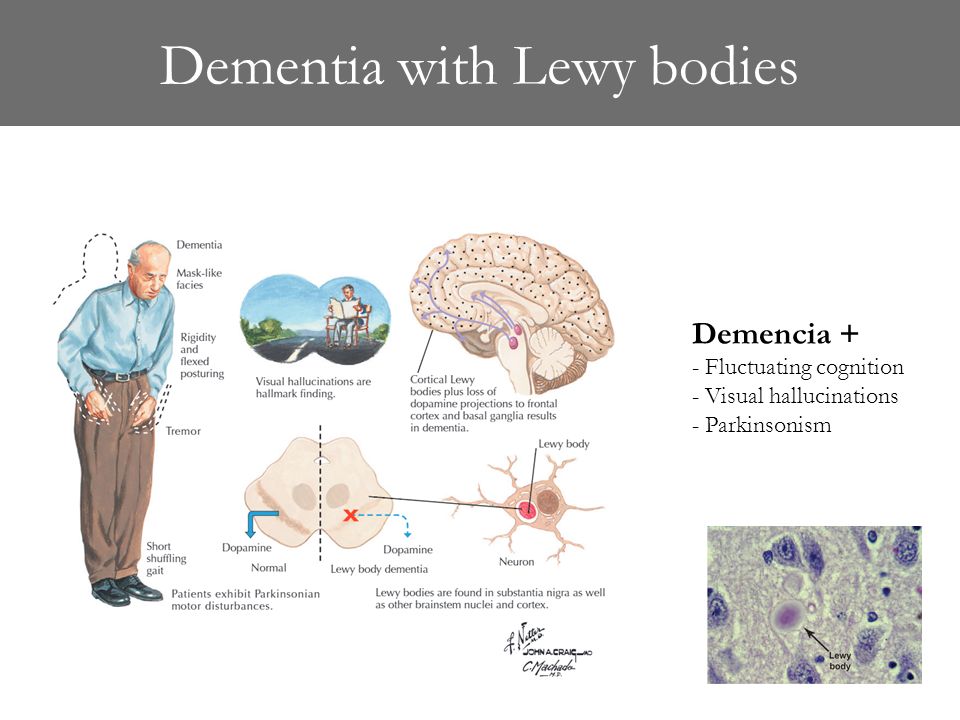 Lewys body dementia