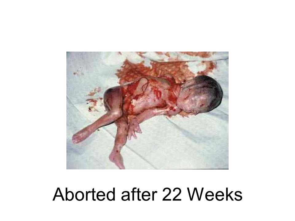 Aborted after 22 Weeks