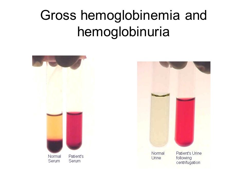 Gross hemoglobinemia and hemoglobinuria