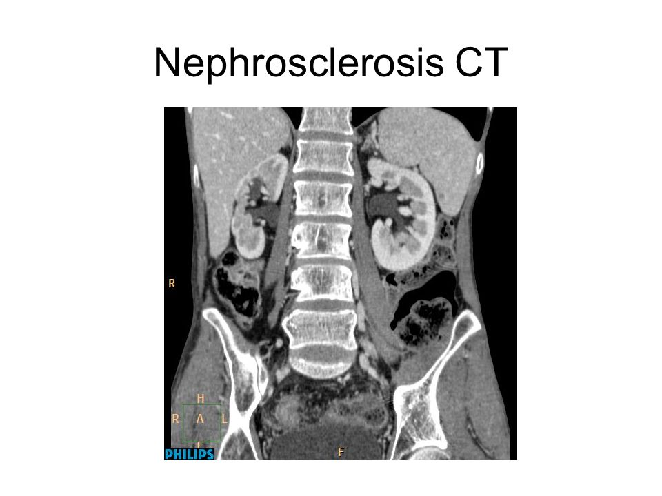 Nephrosclerosis CT