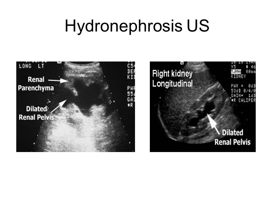 Hydronephrosis US