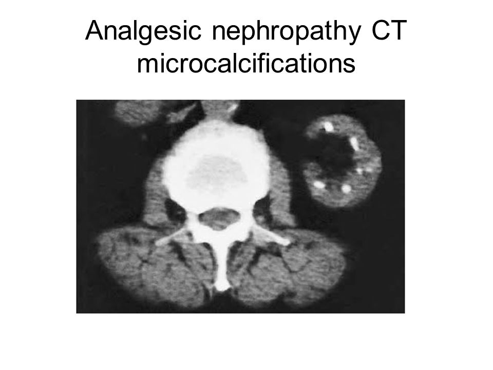 Analgesic nephropathy CT microcalcifications