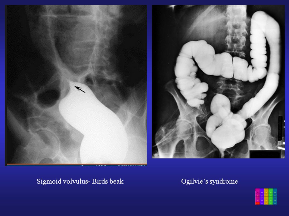 ogilvie syndrome